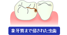 象牙質まで侵された虫歯
