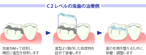 C2レベルの虫歯の治療例