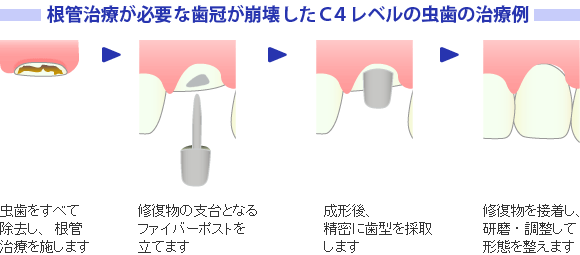 根管治療が必要な歯冠が崩壊したＣ４レベルの虫歯の治療例