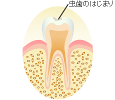 初期の虫歯