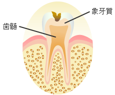 象牙質の虫歯