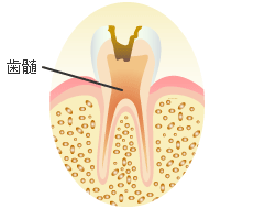 歯の神経（歯髄）まで侵された虫歯
