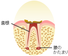 末期の虫歯