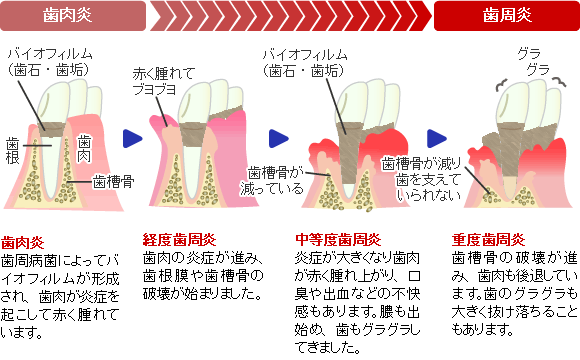 歯周病の進行