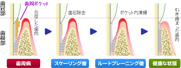 ルートプレーニング