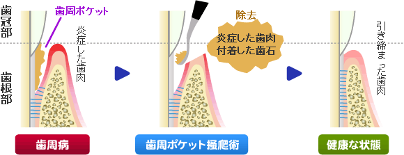 歯周ポケット掻爬(そうは)術