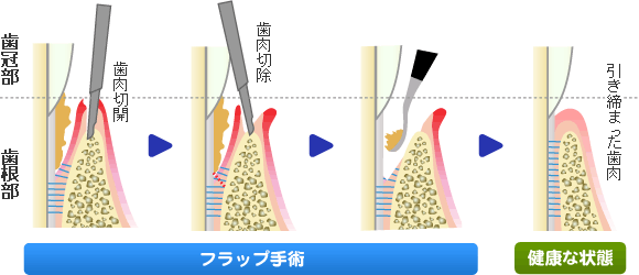 フラップ手術（歯肉剥離掻爬手術）