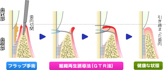 組織再生誘導法（ＧＴＲ法）