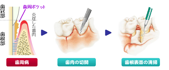 エムドゲインゲルによる歯周組織再生療法