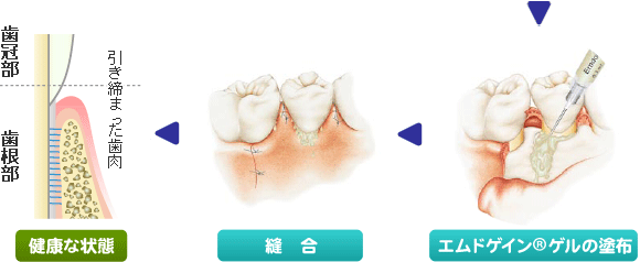 エムドゲインゲルによる歯周組織再生療法