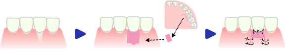 根面露出と結合組織移植術