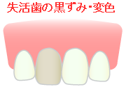 失活歯の黒ずみ・変色