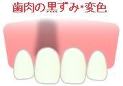 歯肉の黒ずみ・変色