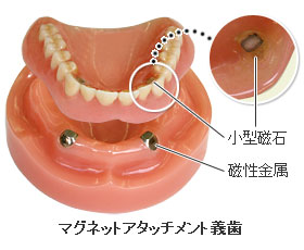 マグネットアタッチメント義歯