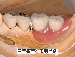 歯型模型への装着例