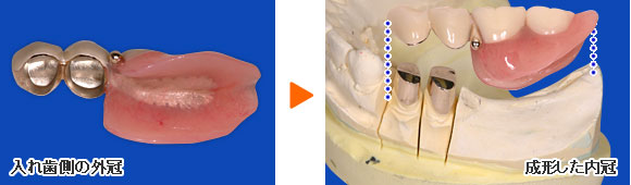 歯型模型への装着例