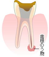 歯根のう胞摘出術
	