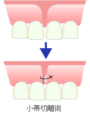 小帯切除術