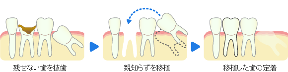 歯牙移植