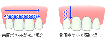 歯周病の治癒促進