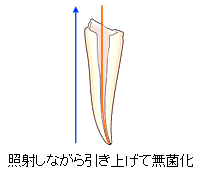 根管治療（歯内療法）