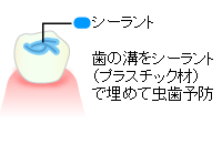 シーラント